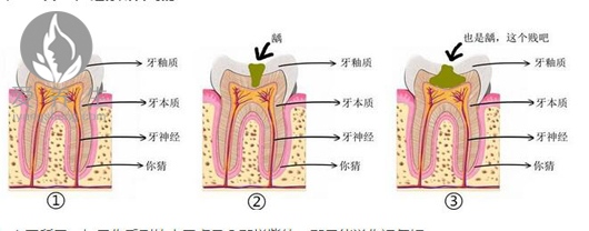 牙齿上有小黑点原来这么可怕