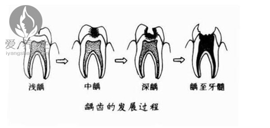 牙齿上有小黑点原来这么可怕